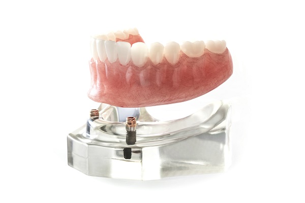 インプラント義歯治療